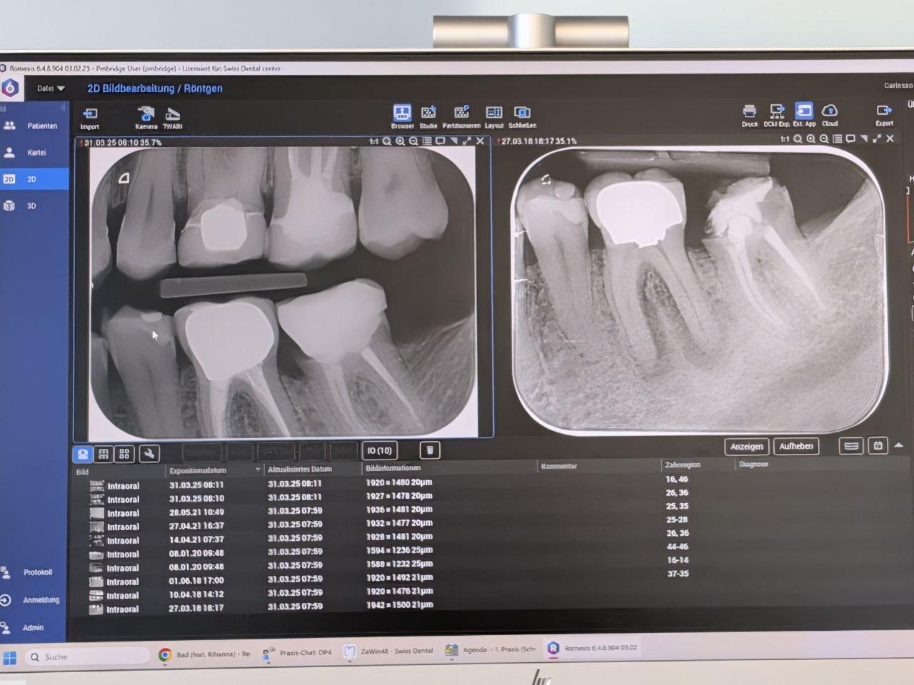 Dental X-Ray